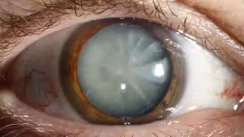 Cloudy eye lenses
