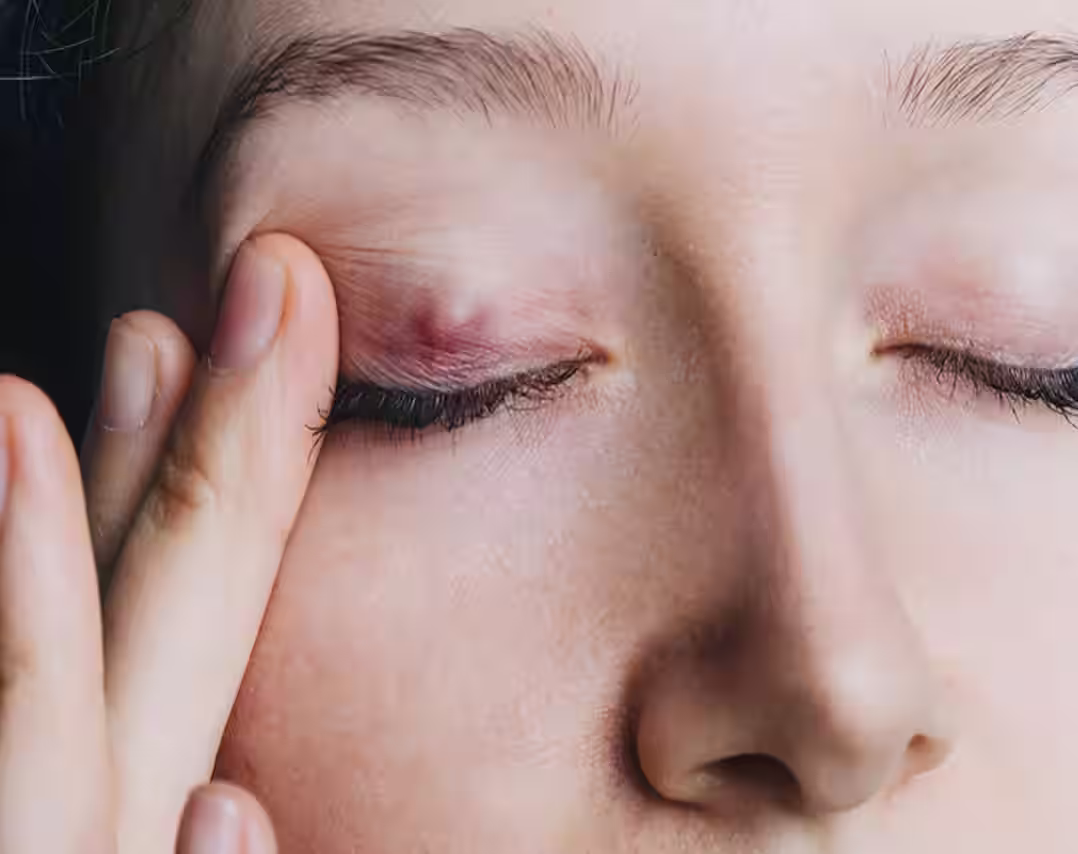 Chalazion Cause