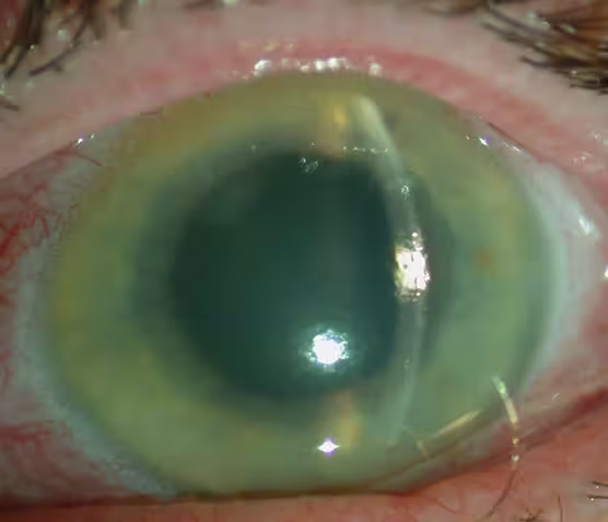Glaucoma danger