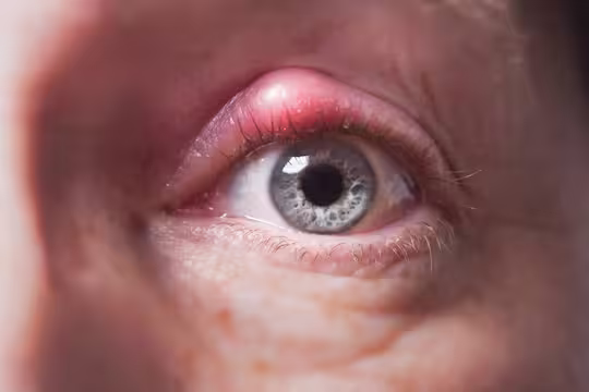 Chalazion Symptoms