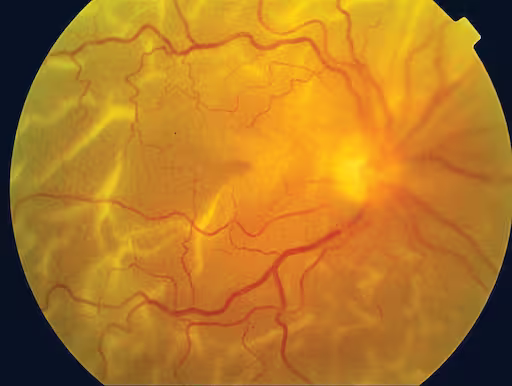 Detached Retina cure