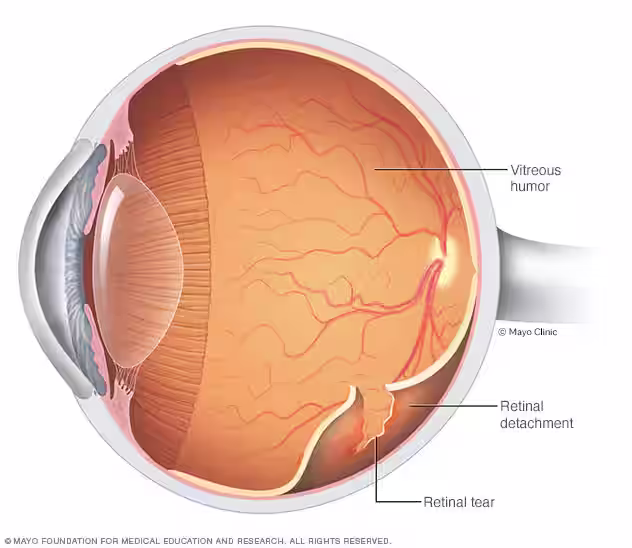 Detached Retina treatment