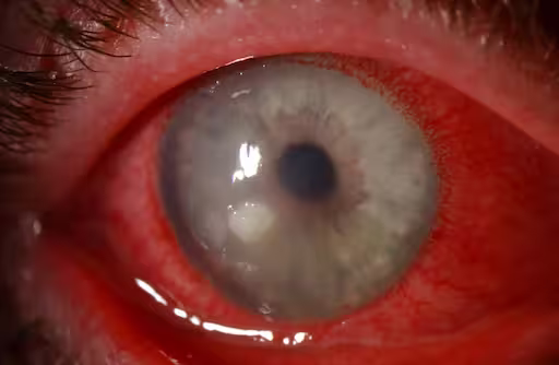Keratitis treatment