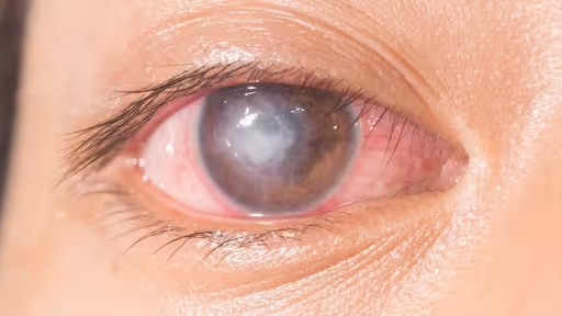 Keratitis