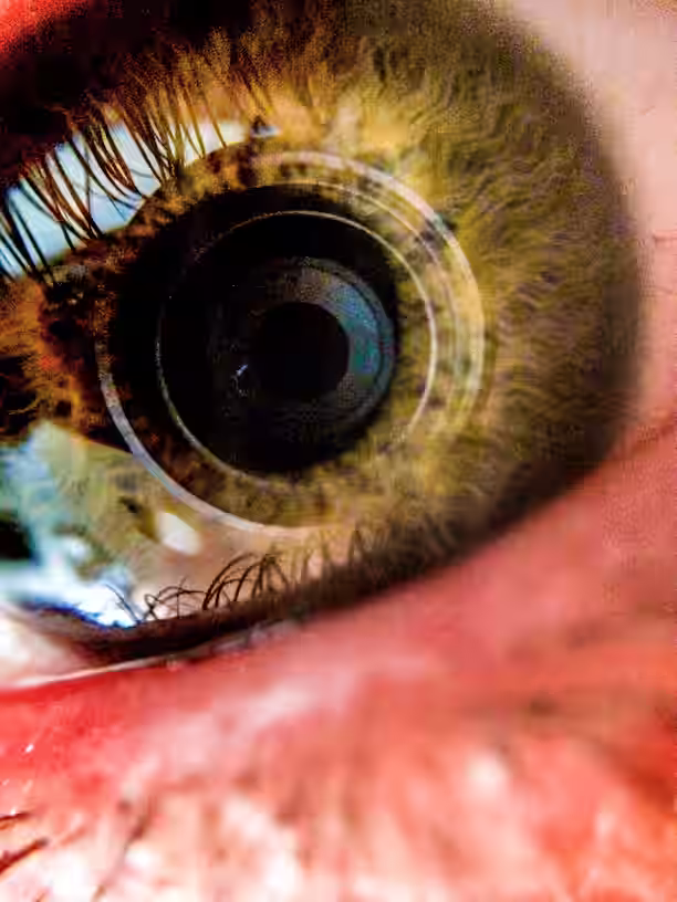 Macular Degeneration treatment