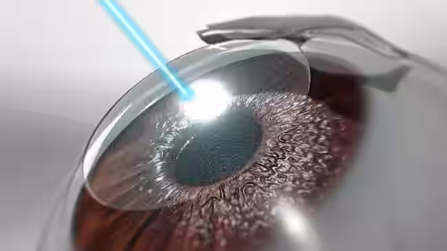 LASIK eye surgery cost in Dubai at Ebsaar Eye Surgery Center