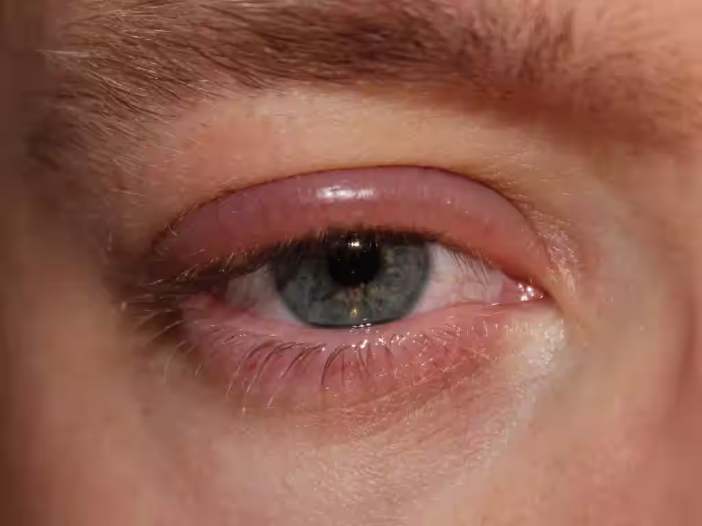Blepharitis causes