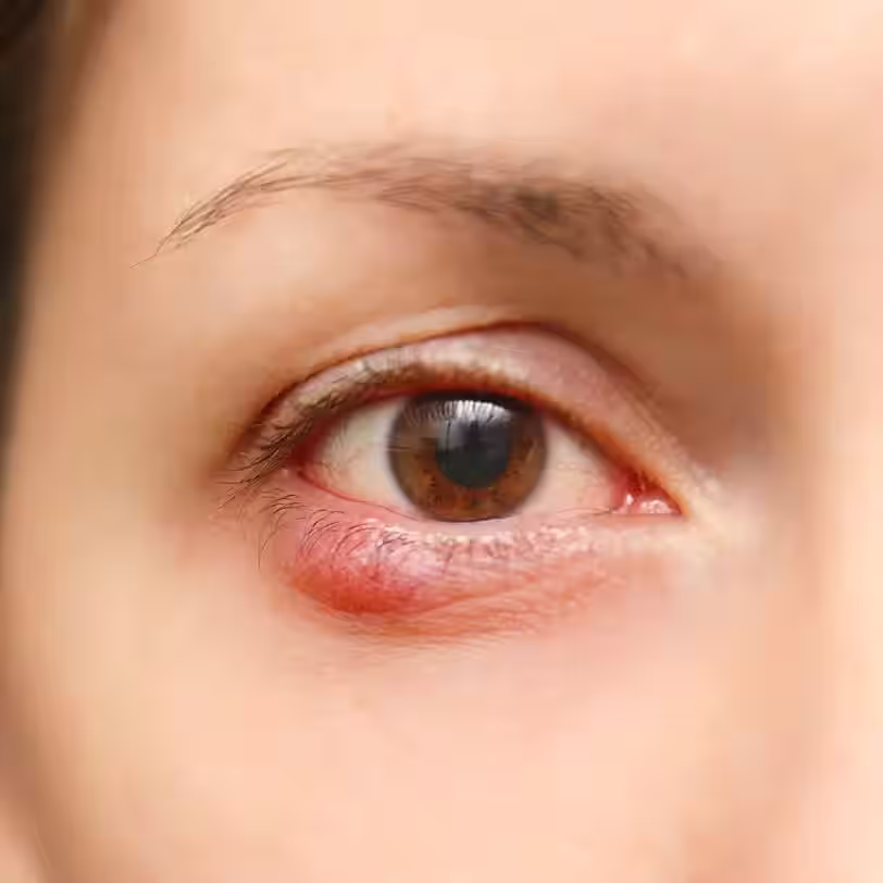 Blepharitis